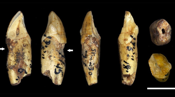 Human ancestors had the same dental problems as us – even without fizzy drinks and sweets
