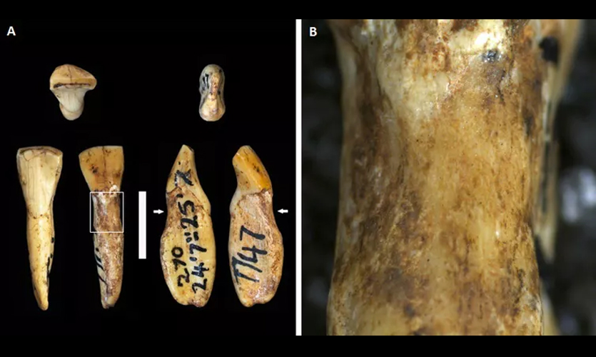 Lesions on fossilised teeth