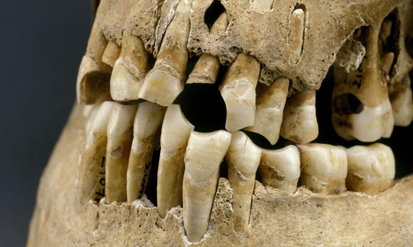 A 17th-century jaw with a gap where a clay pipe was held